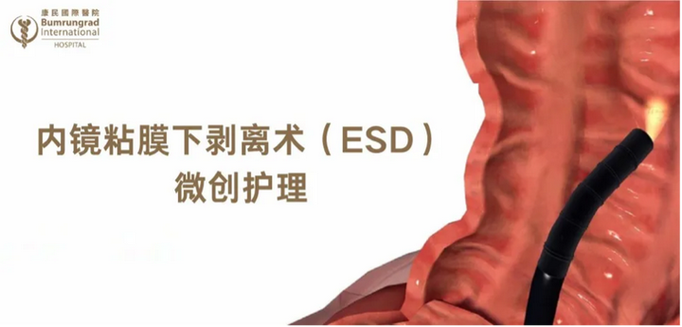 外层剥离技术elo,原理是什么?-图2 外层剥离技术elo,原理是什么?-图2