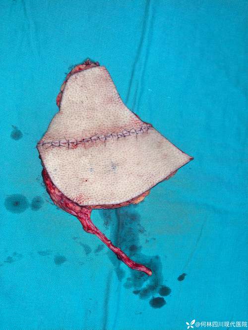 外层剥离技术elo，原理是什么？-图3