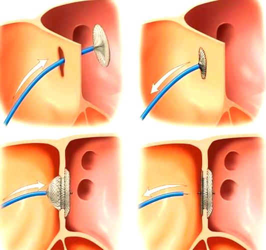 Buddy技术如何有效介入？-图1