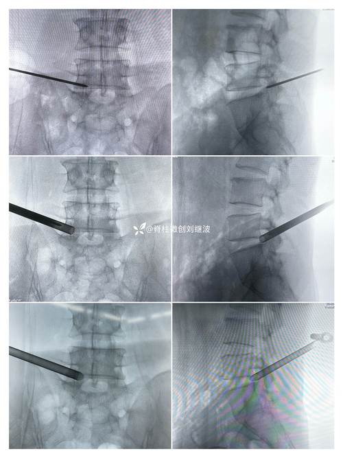 德国思科椎间孔镜品牌-图3